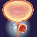 Kanseri ya Prostate: Ibimenyetso Byayo Byose n’Uko Wayirinda Hakiri Kare.
