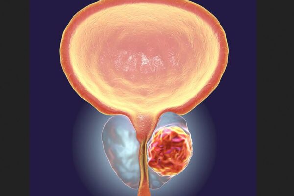 Kanseri ya Prostate